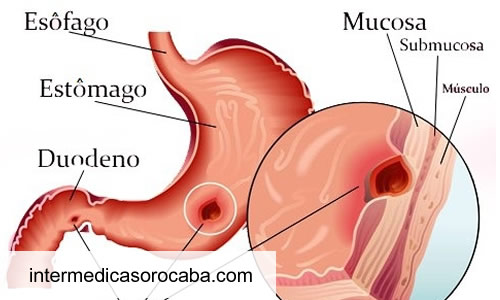 Ulcera nervosa, como esse grande problema atua?